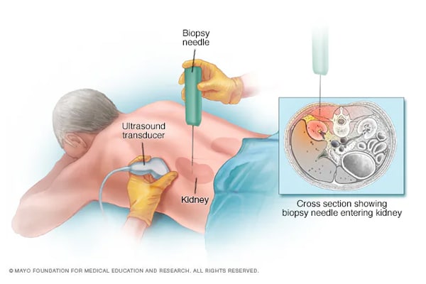 10. Kidney biopsy