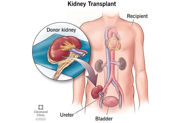 12. Kidney transplatation