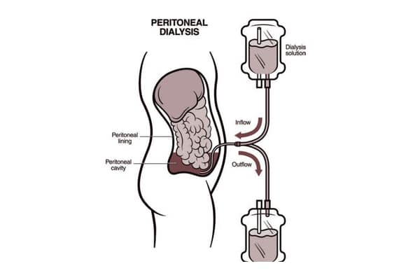 7. Peritoneal-dialysis